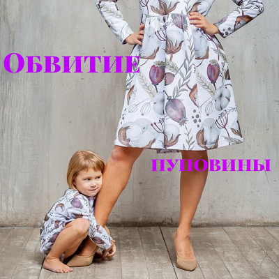 Обвитие пуповины